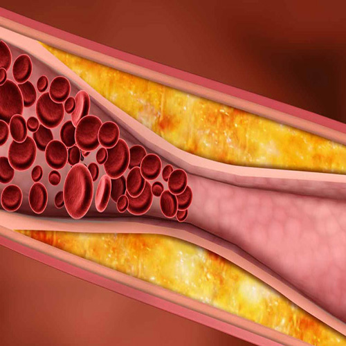 کشف  دارویی جدید برای از بین بردن پلاک های چربی درشریان ها
